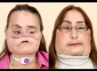 face-transplant.jpg