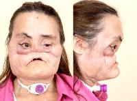 face-transplant2.jpg